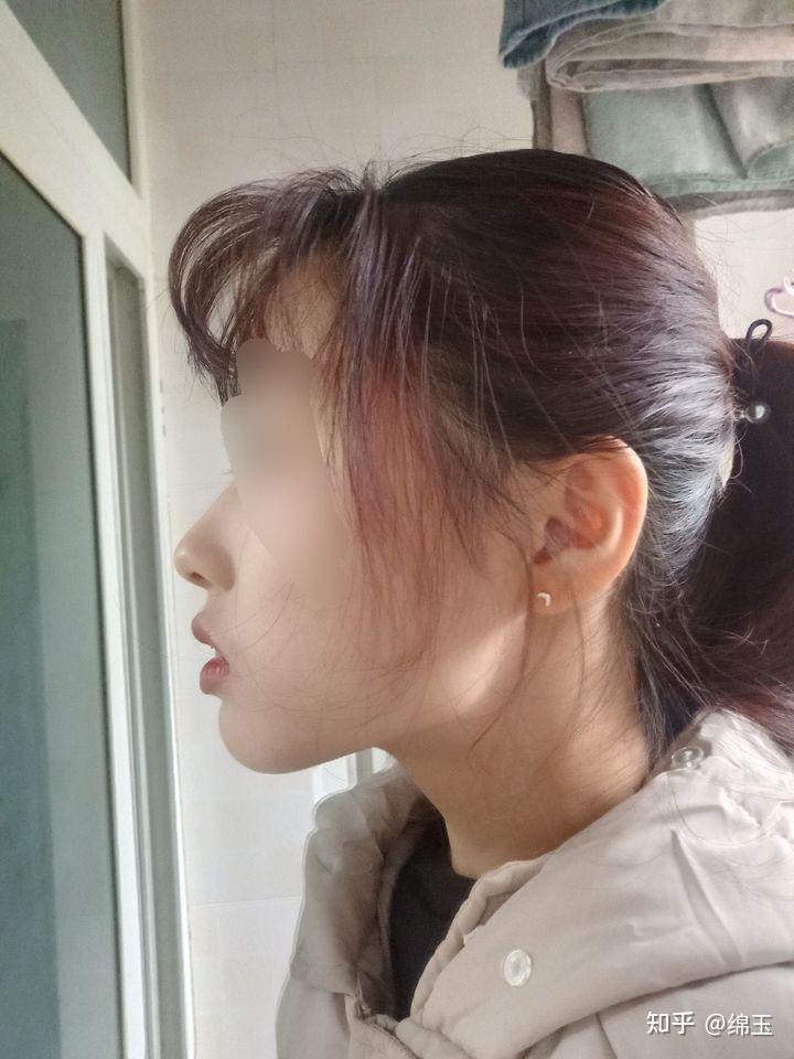 我也开始写牙套记录啦深覆合深覆盖拔牙正畸金属自锁平导重庆19岁女生