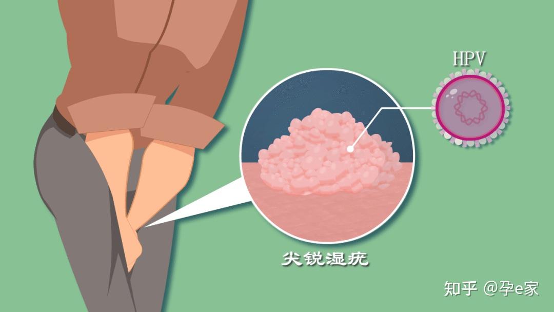 尖銳溼疣(ca),是由人乳頭瘤病毒(hpv)感染外陰,生殖道引起的,以疣狀