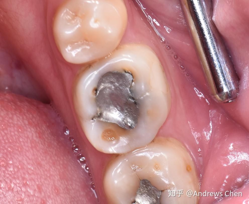 关于补牙假如几年后填充物掉了再次补的话是不是又