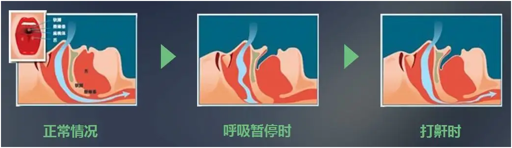 睡眠呼吸暂停综合症的种类你了解吗?一起来看看吧! 