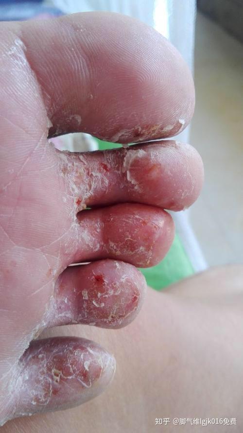 脚气这一招全好啦