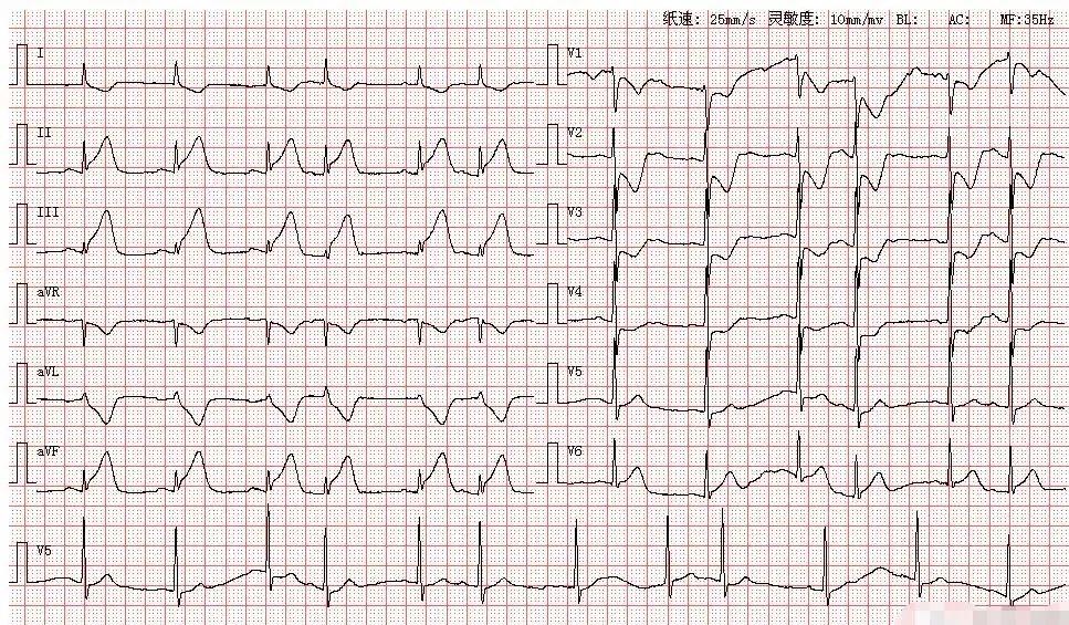 心电图图库丨心肌梗死系列