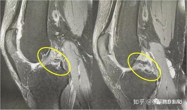 五分鐘瞭解膝蓋後十字韌帶拉傷如何恢復?