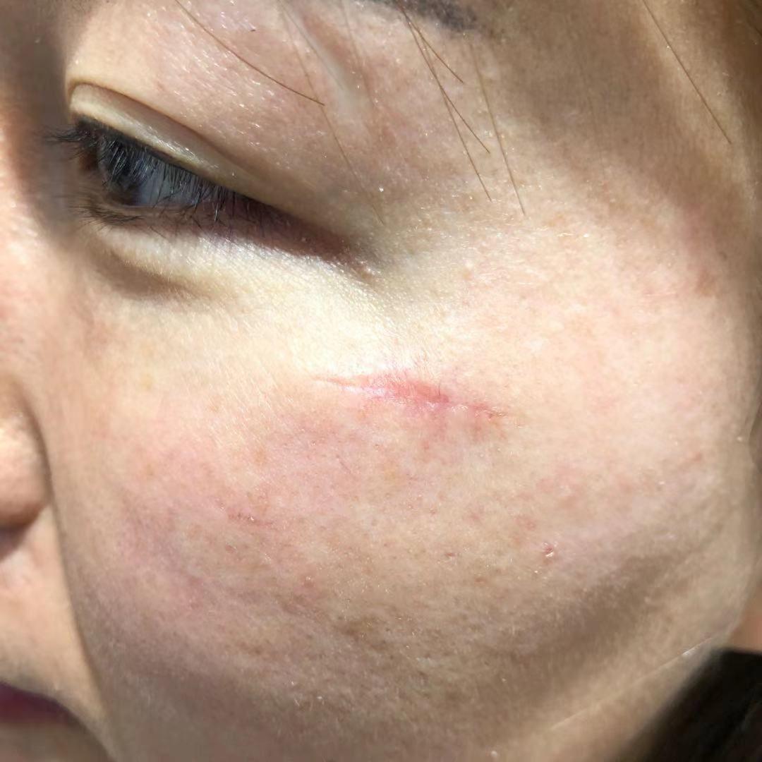 脸上很久的疤怎么去除?有点类似于缺了一块肉的那种伤痕?
