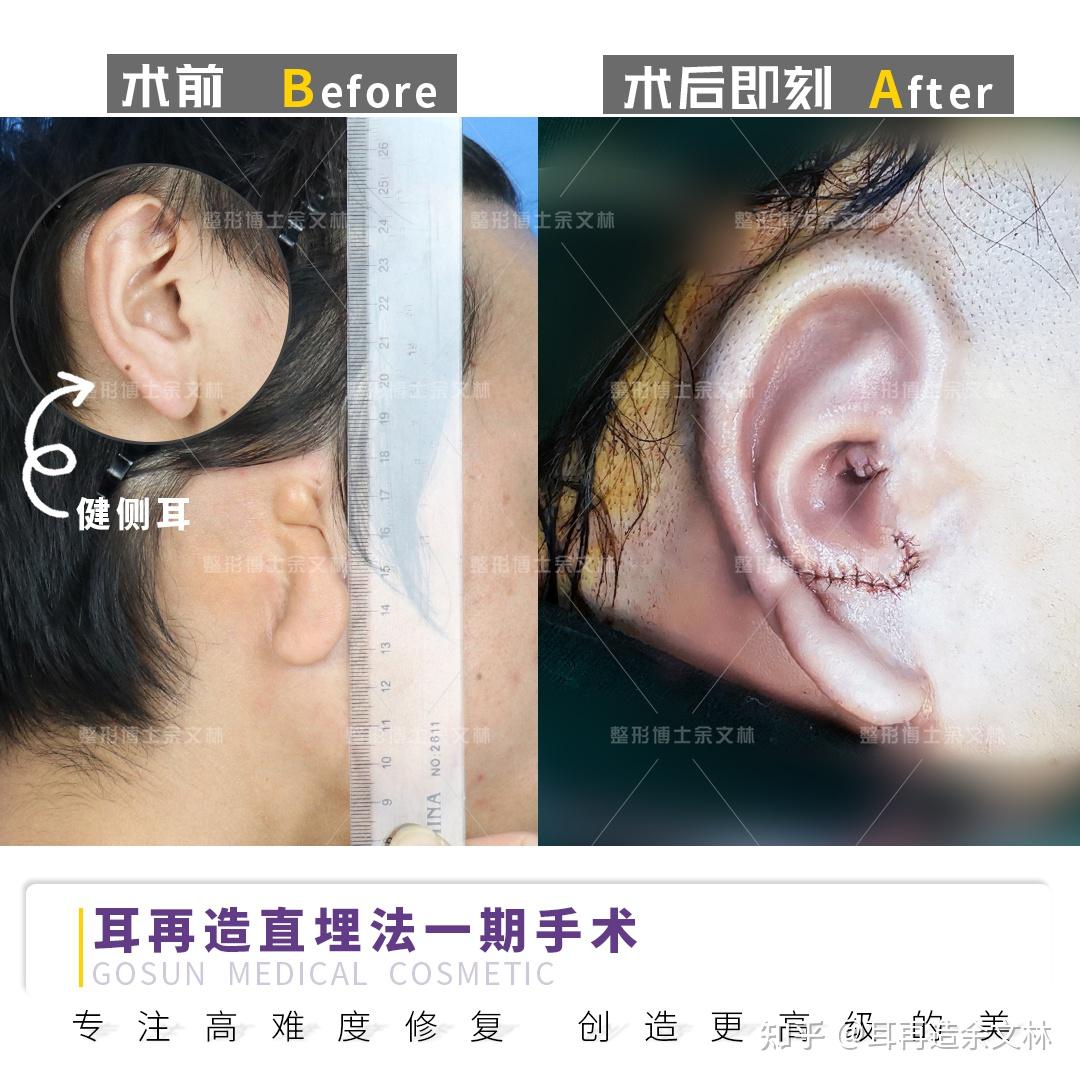 小耳畸形手术后照片 - 哔哩哔哩