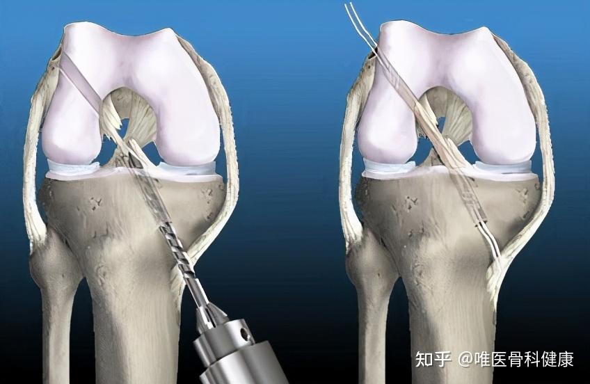 科學麵對前交叉韌帶損傷骨科醫生這4點一定要了解