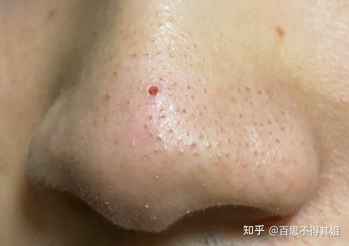 鼻子周围总是有油脂,然后挤出来在鼻子上留下一个小洞,很明显怎么办?
