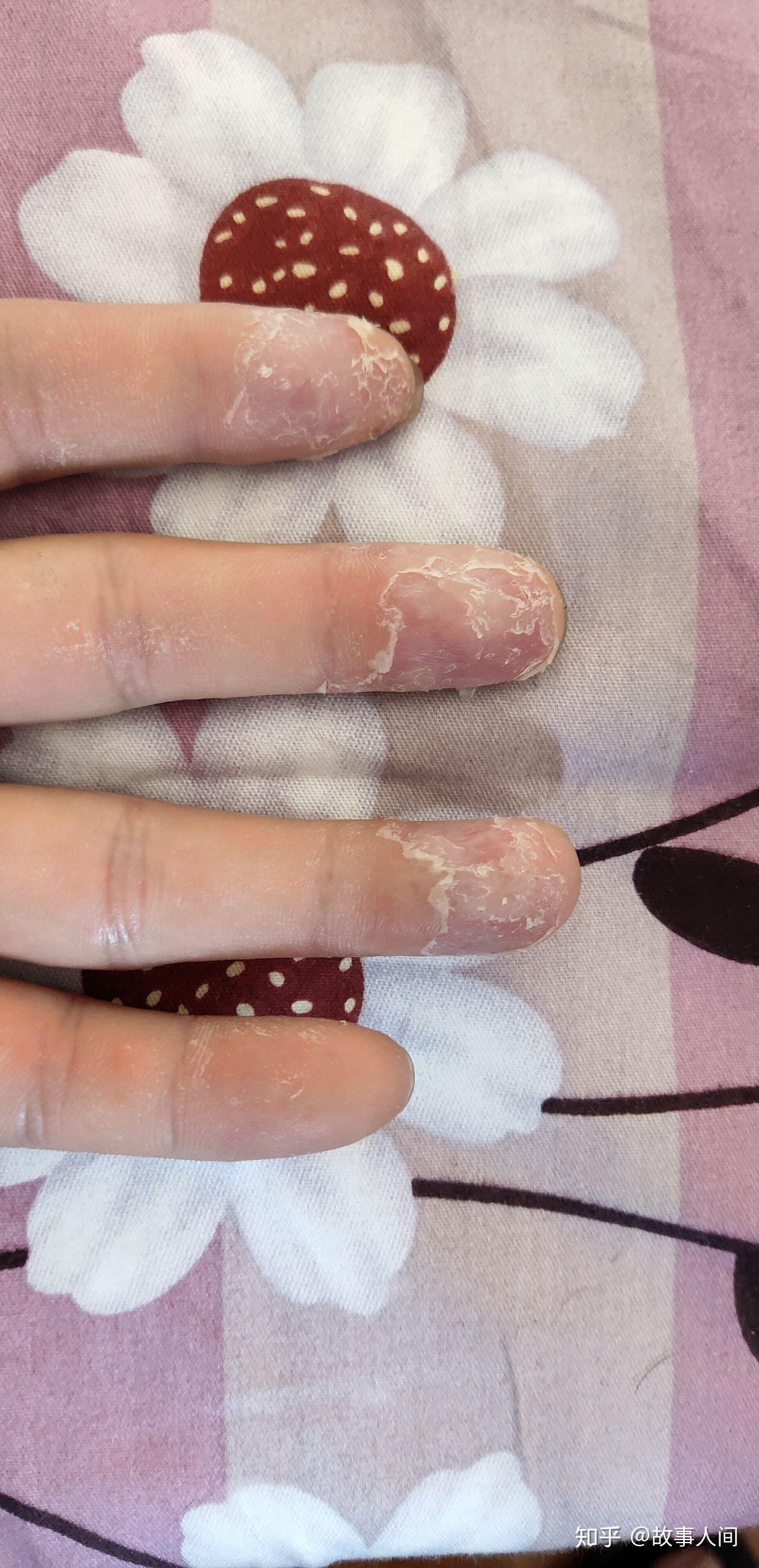 怎样治疗剥脱性角质松懈症