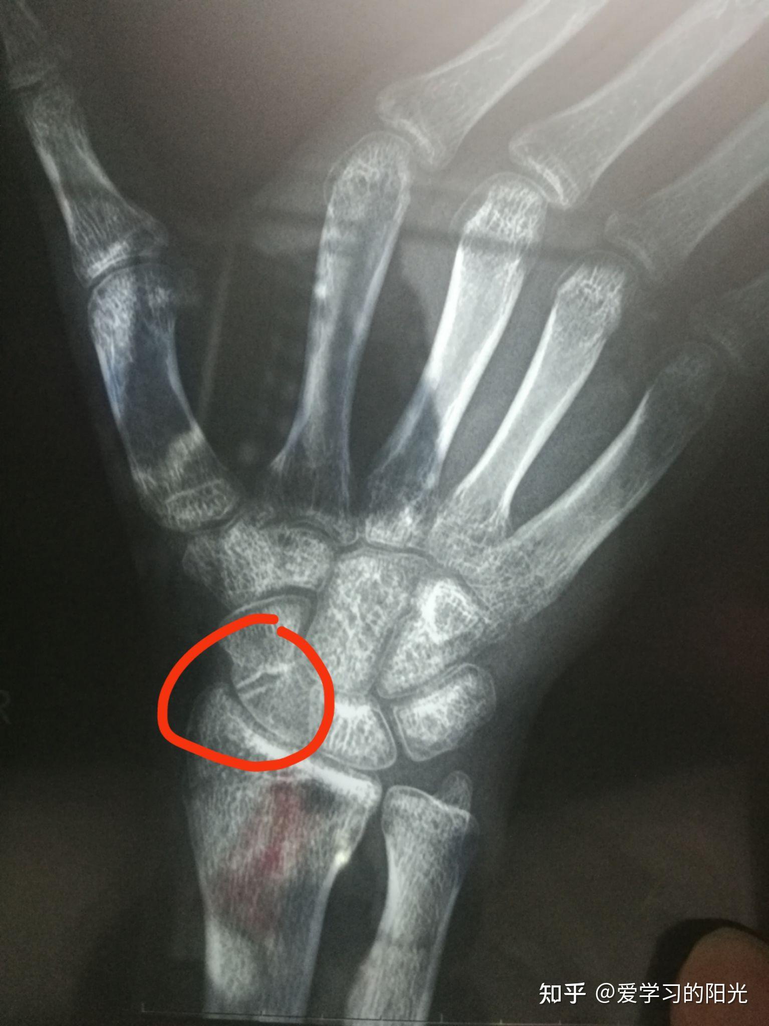 右手腕舟状骨骨折多久全愈
