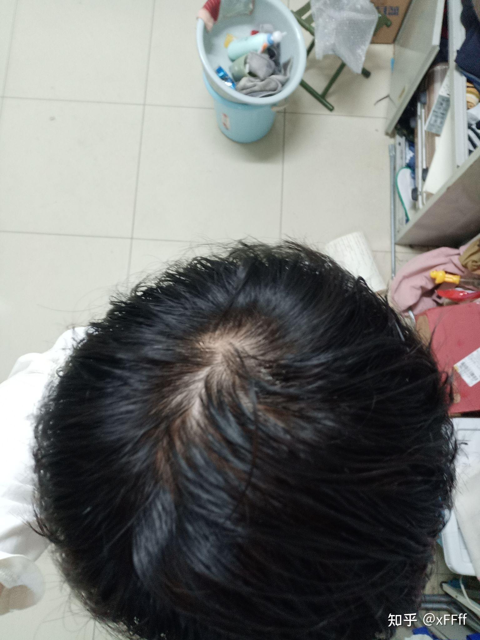 发旋处头发太少了我是不是要秃了怎么办啊