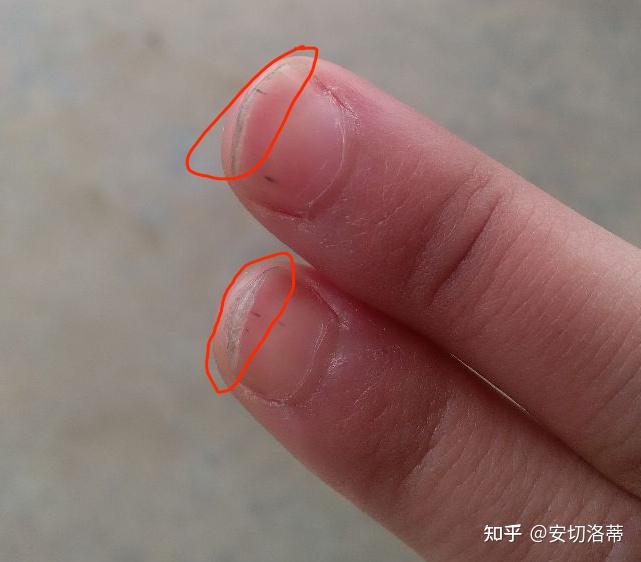 灰指甲,还有希望治好么(*@ο@*)有人说用白醋泡好了,真的假的? - 知乎