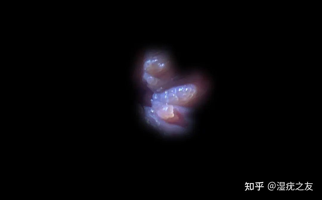 下体长疙瘩不痛不痒,会是尖锐湿疣吗?(内附图)