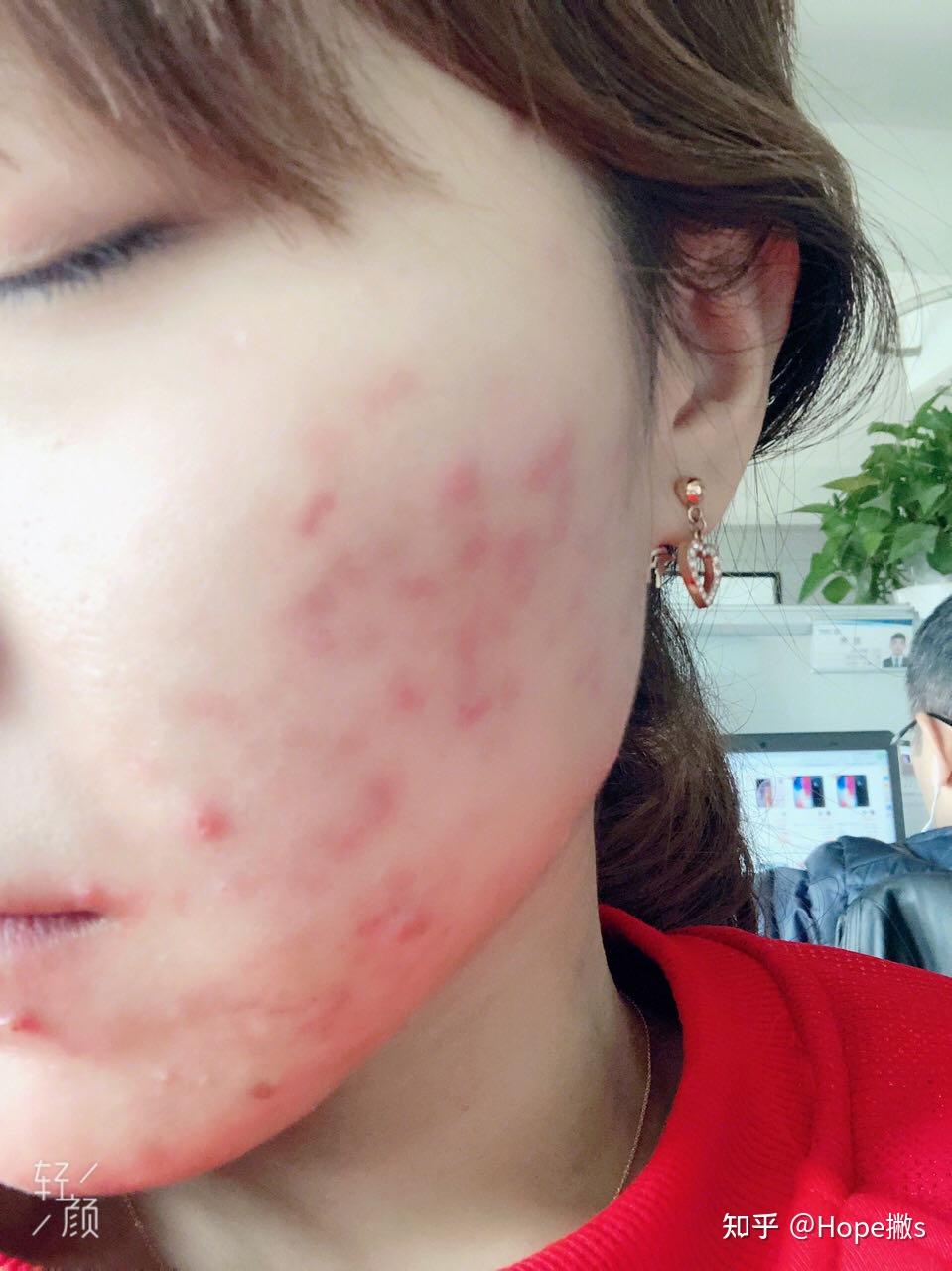 脸上左边脸颊长了一个痘,第一天晚上我涂了狮王祛痘膏,第二天痘干了