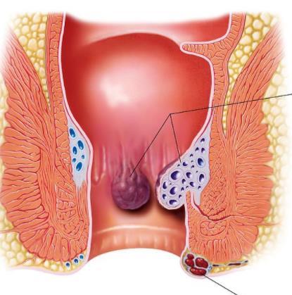 在校大学生是怎么消除自己鸡蛋大的痔疮外痔肉球的你学会了吗