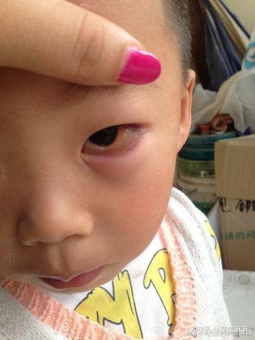 但是随着宝宝不断地生长发育,宝宝的眼睛也可能会遇到许许多多的威胁