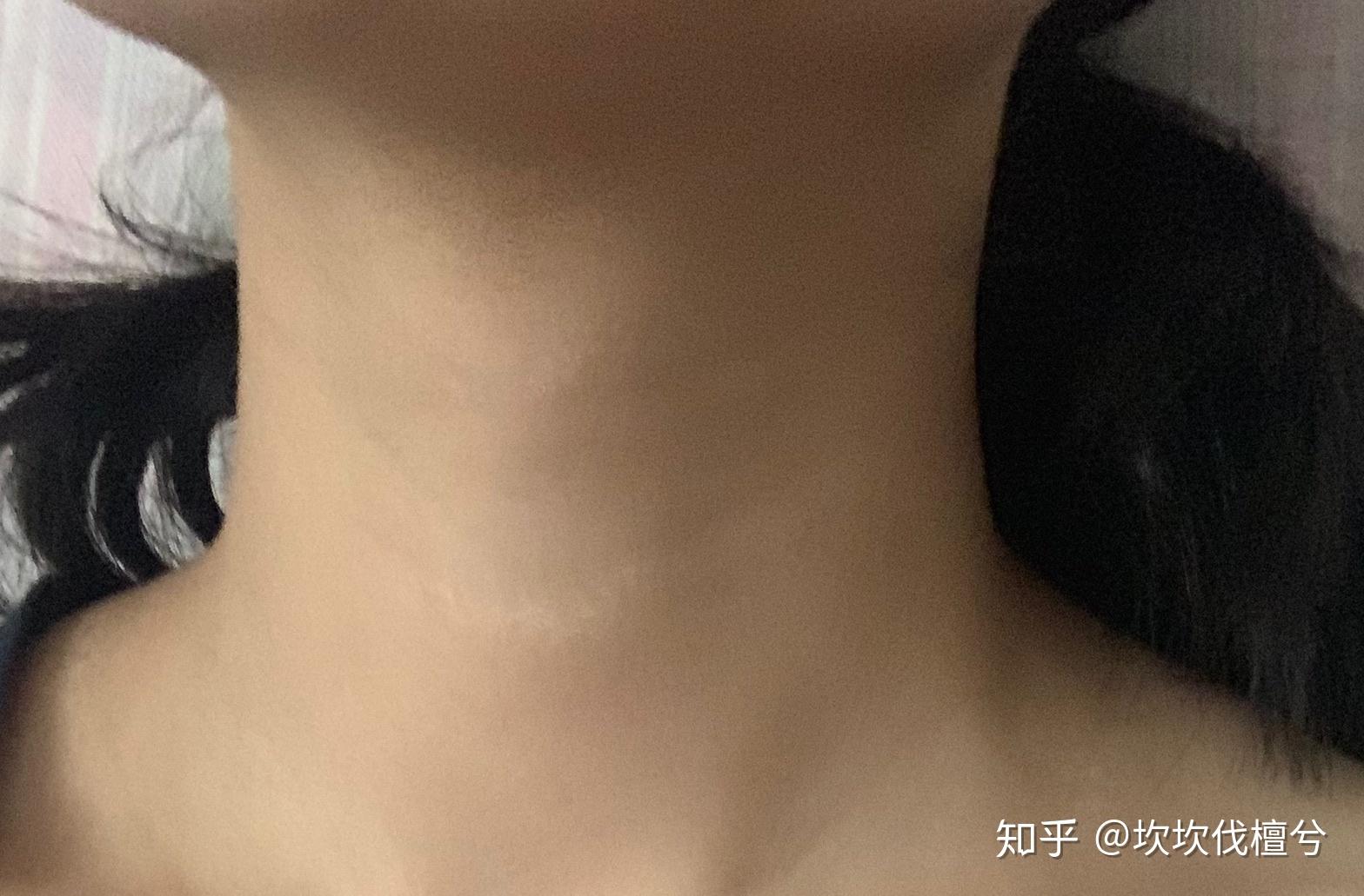 女生长喉结怎么办是因为太瘦了还是激素分泌不正常