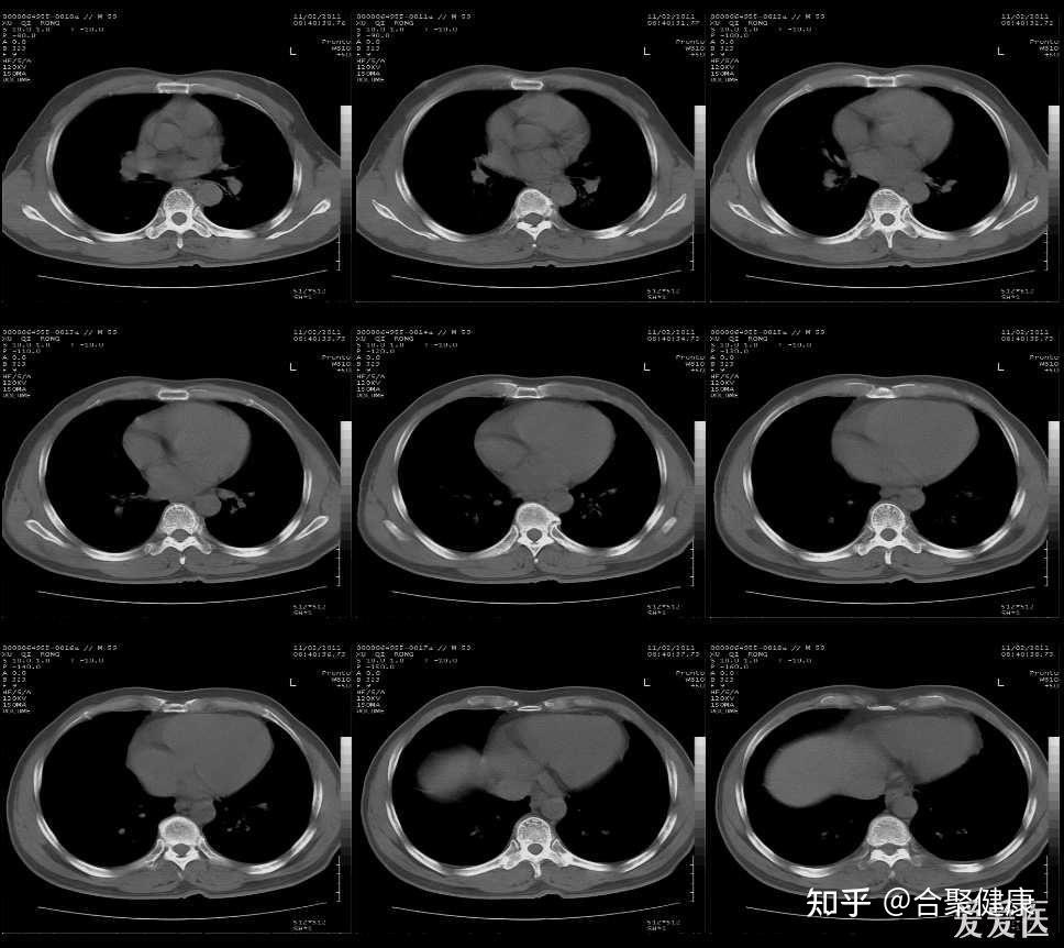 体检科普 | 胸片or胸部CT?傻傻分不清楚! - 知乎