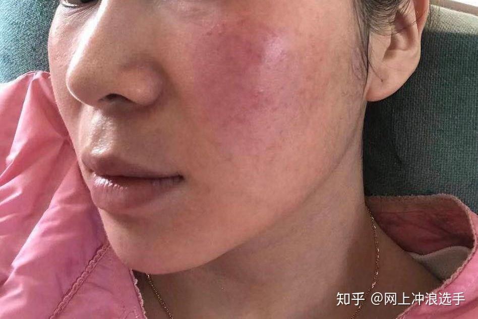 本人有红血丝想问一下有没有适合敏感肌用的护肤品看了太多帖子已经做