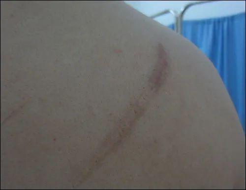 浅表性疤痕需要治疗吗?