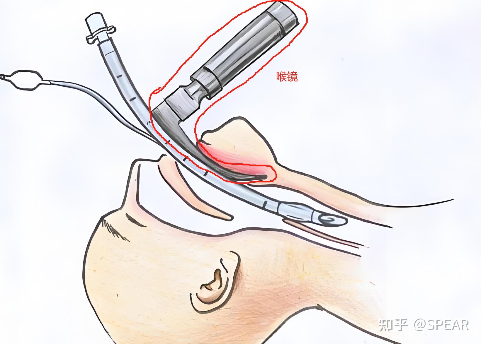 气管插管设备指哪些?应该怎么选购呢?