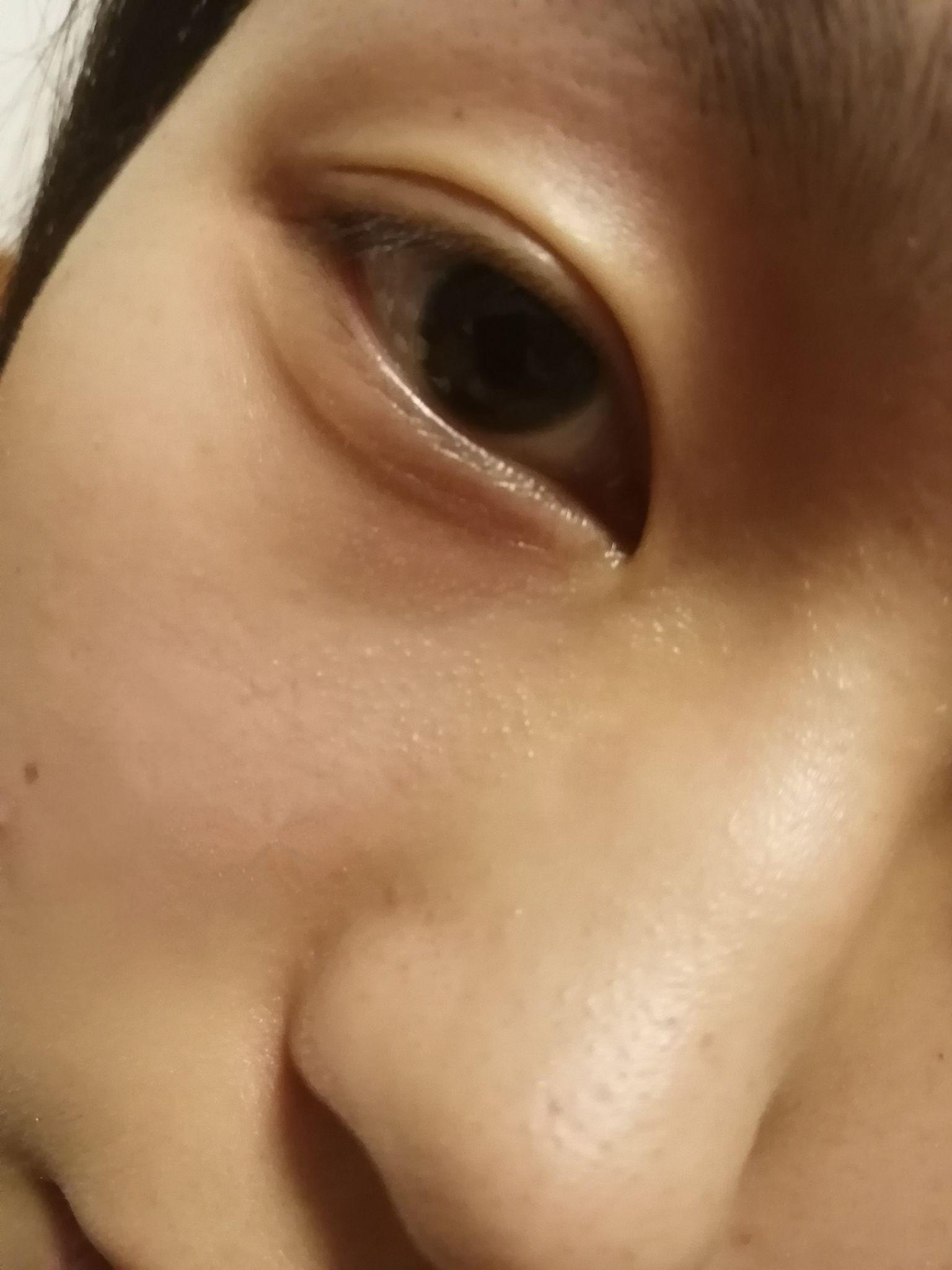 下眼睑上有一条不明显的线为什么有的人没有