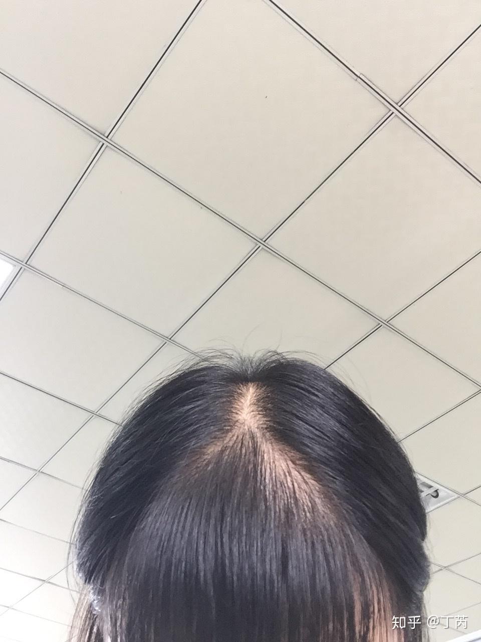 妹纸弥漫性脱发的植发经历