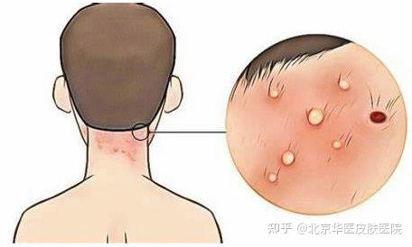 患有毛囊炎会有哪些危害呢