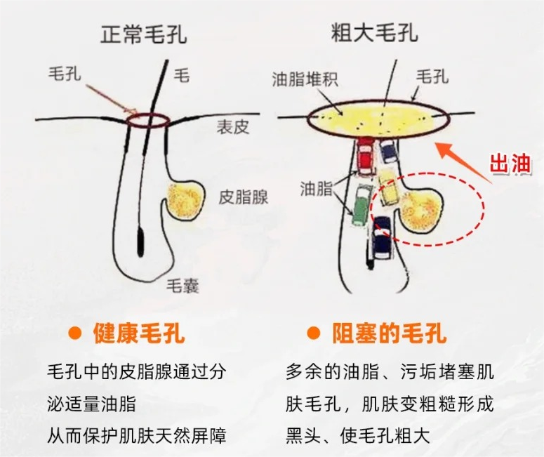 女生脸上毛孔粗大怎么办?感觉遭嫌弃了,有什么收缩毛孔的好方法吗?【三甲医生警告】用错方法会拖成