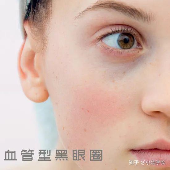 贵妇眼霜真的有用吗怎么才能快速去除黑眼圈