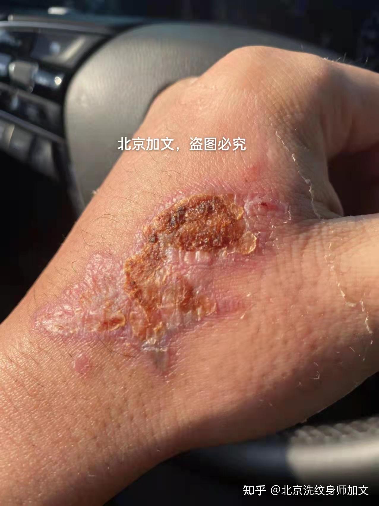 洗纹身留下的伤疤治疗好的效果全过程