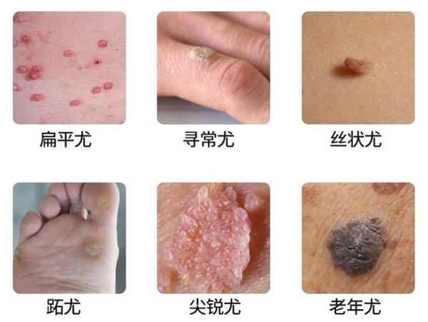 偏方治扁平疣、瘊子、跖疣、尖锐湿疣的要点 - 知乎