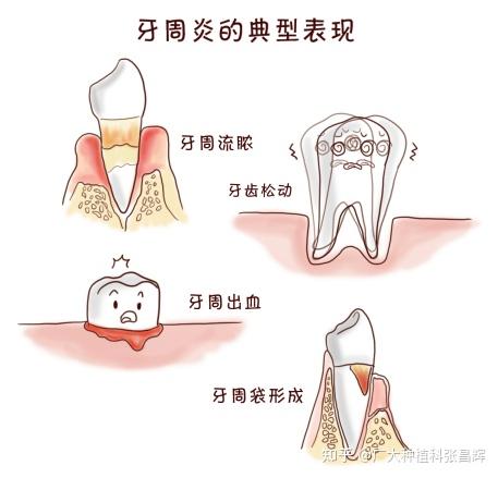 牙周炎的典型表现,快看看你中了多少条 - 知乎