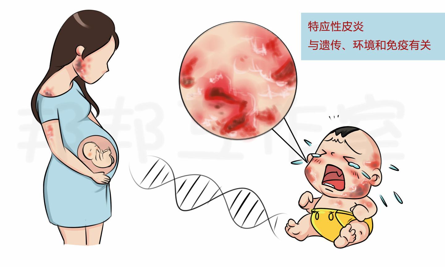 特应性皮炎治疗攻略