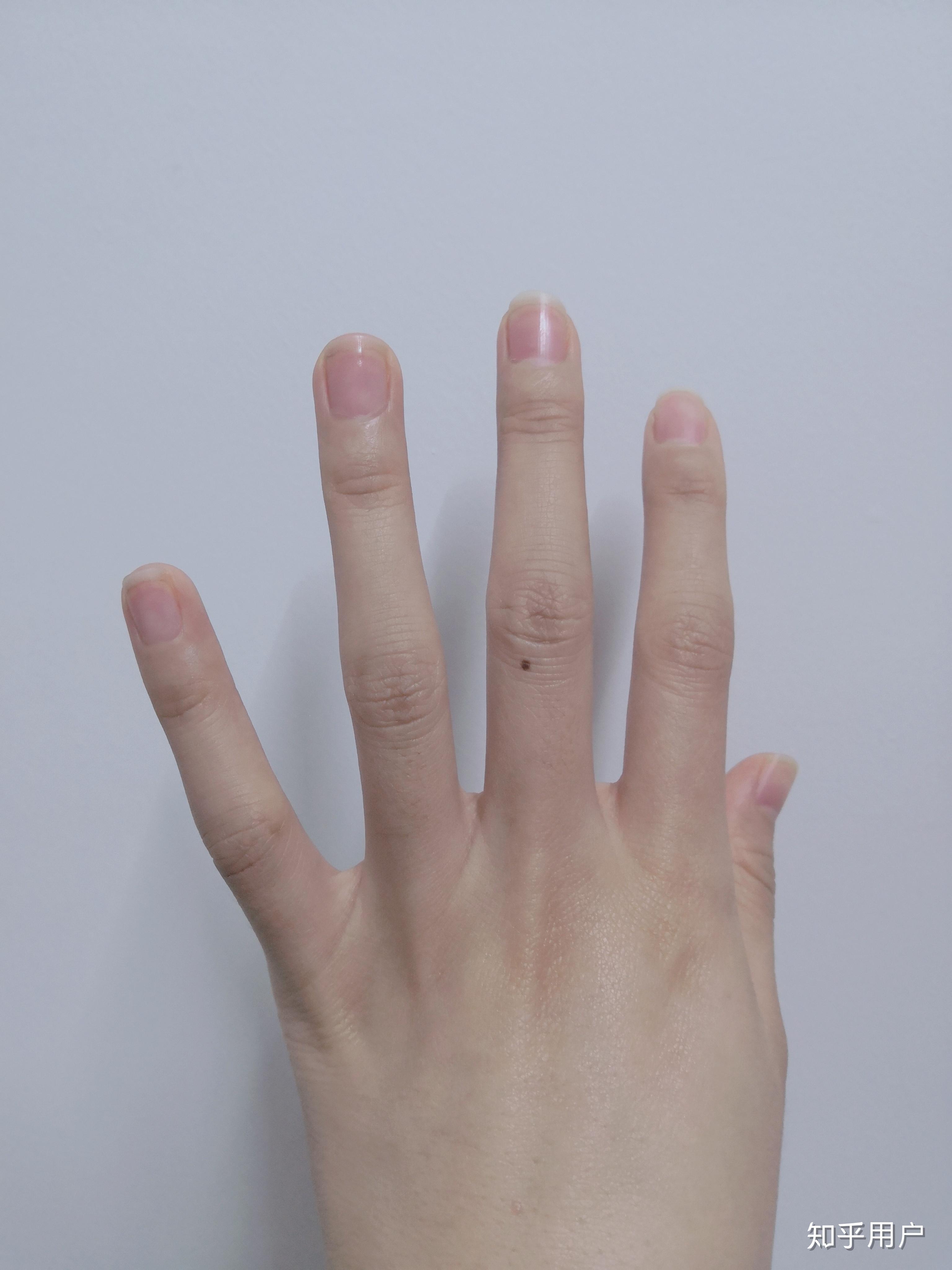 女生右手中指突然长了个小痣代表什麼? - 知乎