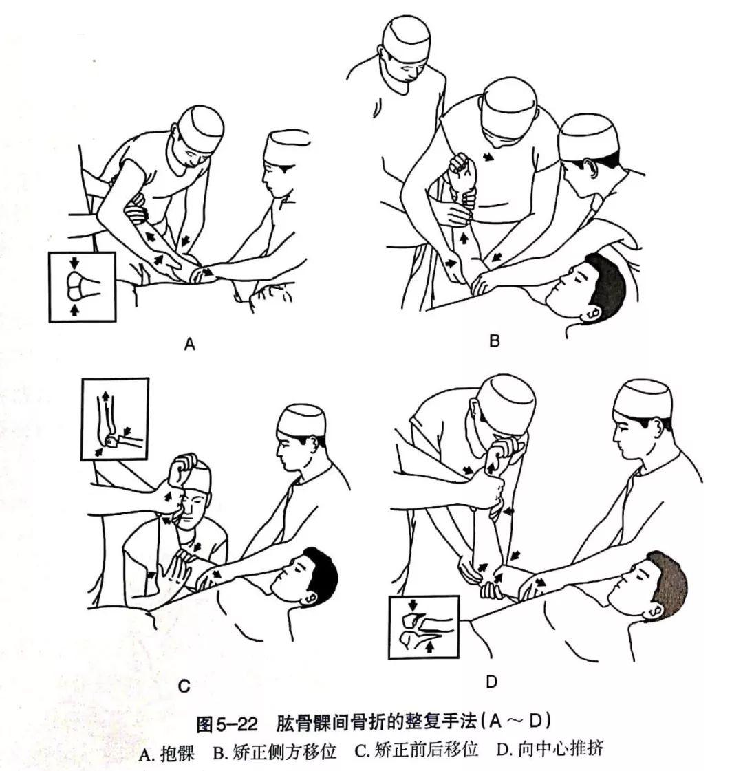 史密斯骨折手法复位图片