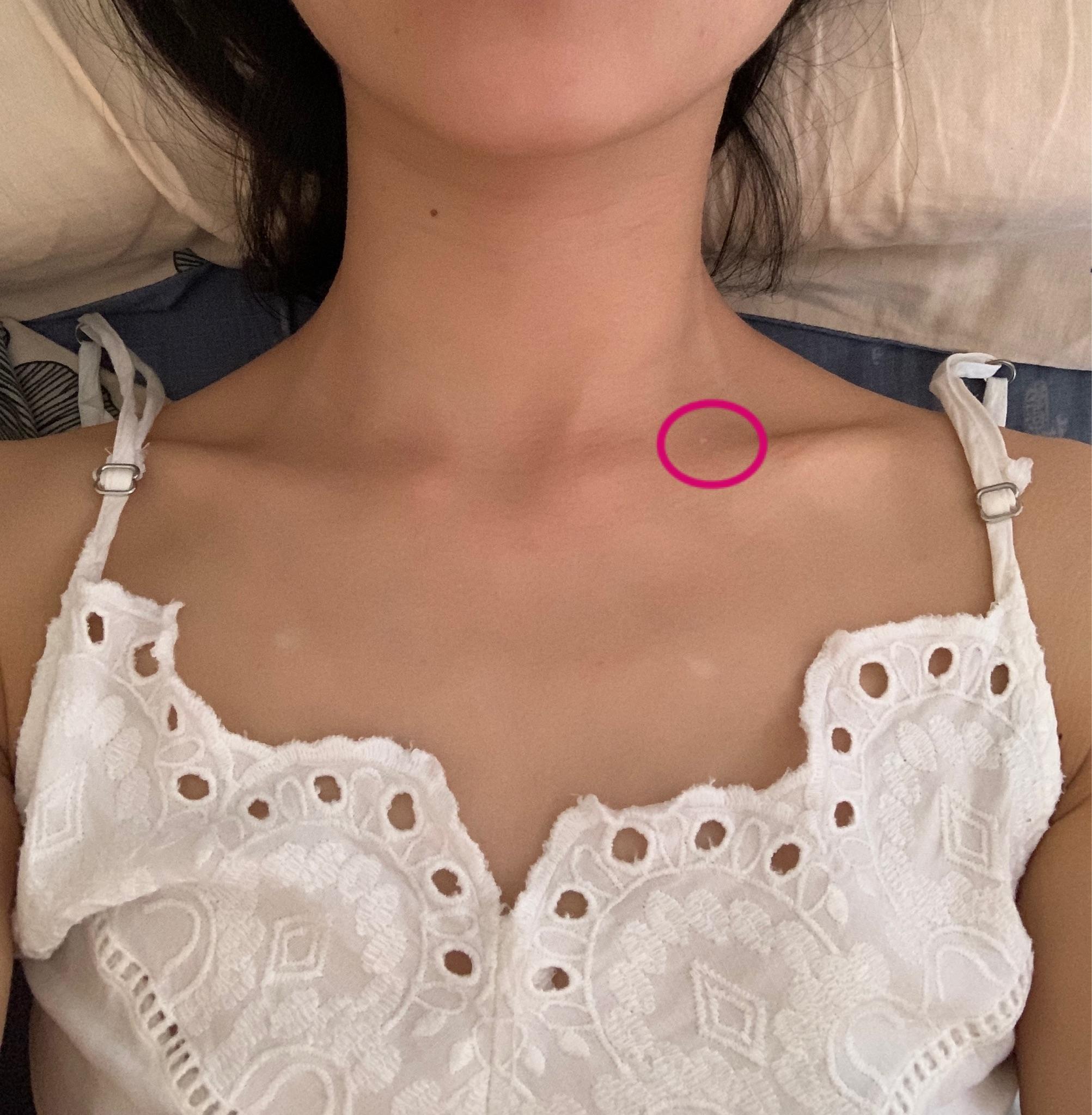 锁骨下面有两个对称的白点是为什么已经好几年了百度了一下可能是