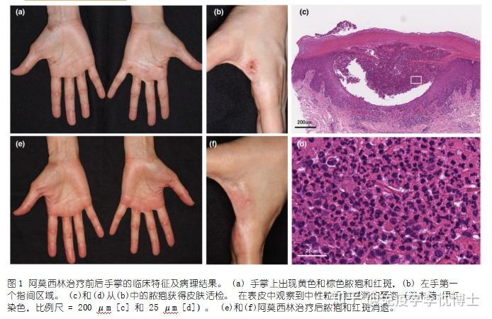阿莫西林成功治疗脓疱性关节骨炎一例报告 - 知乎