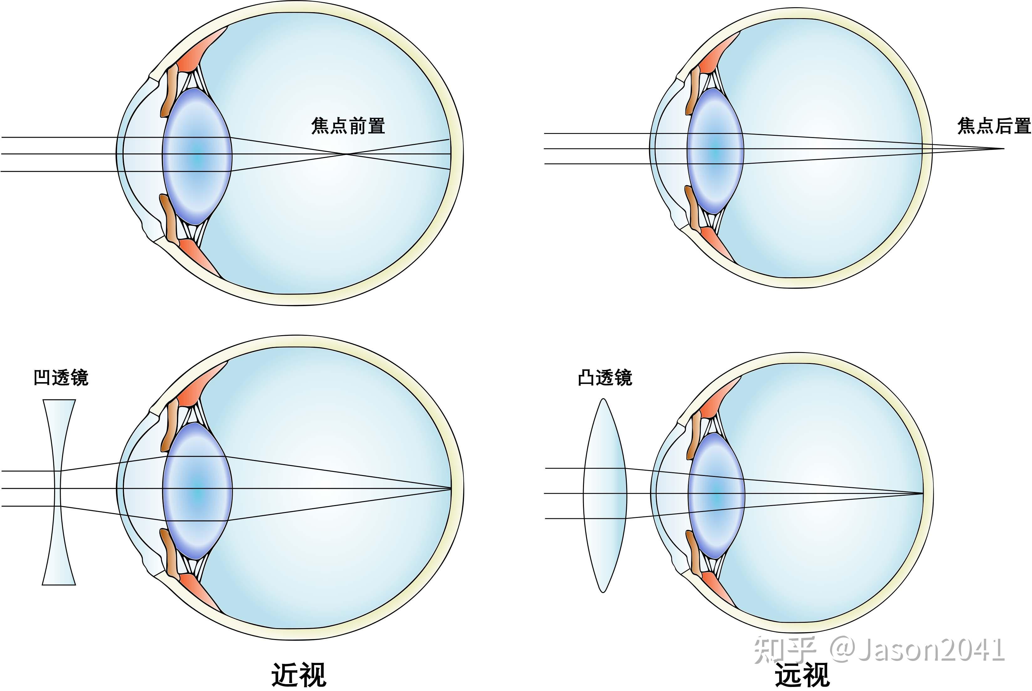 眼屈光不正 - 知乎