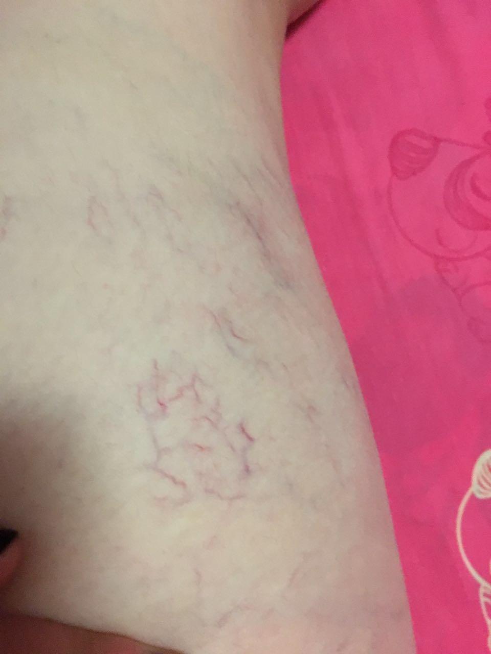 为何大腿外侧毛细血管这么明显?