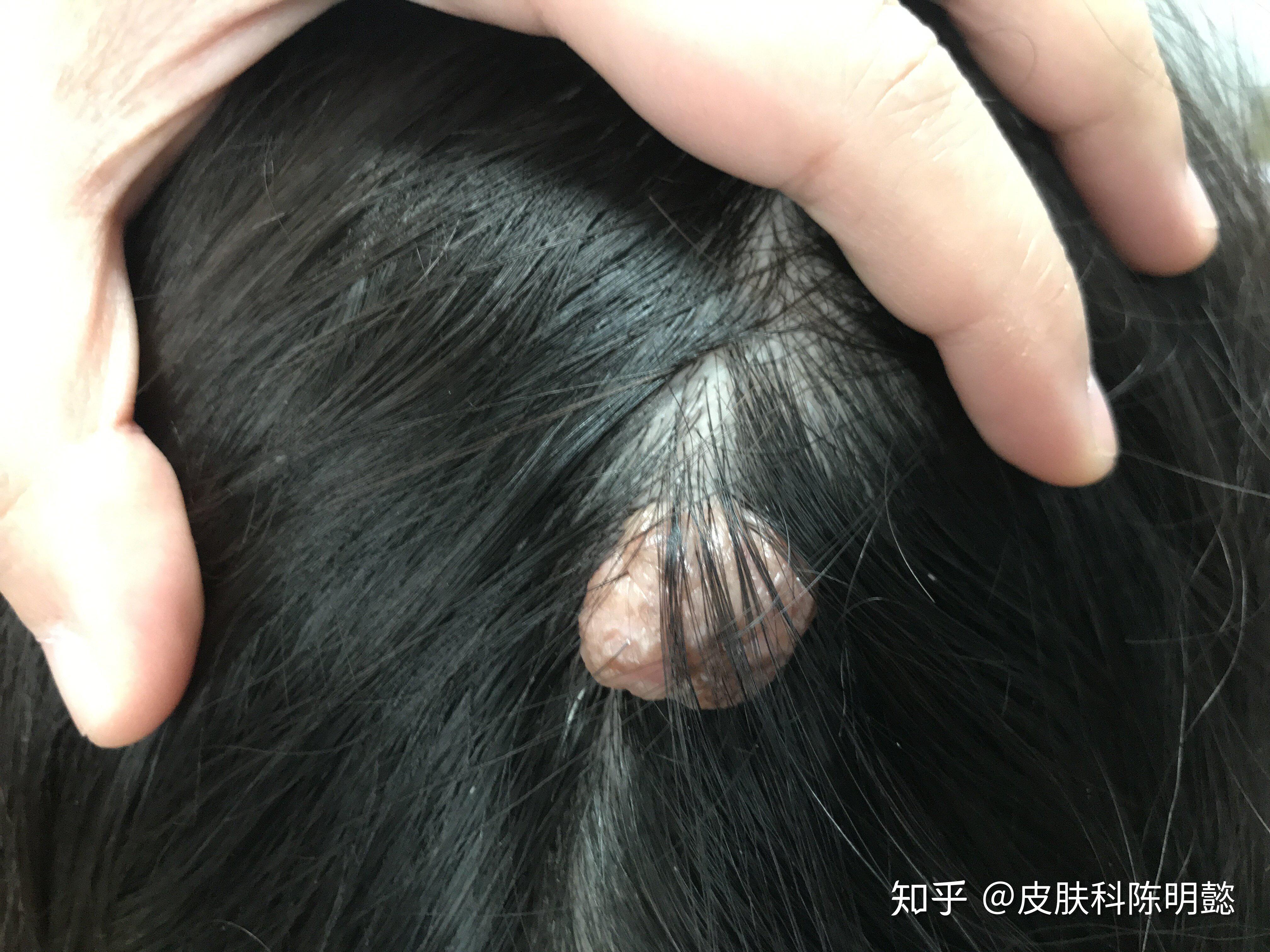 头上的痣能祛吗