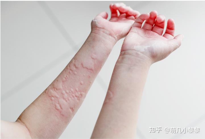 长了这样的疹子,是什么皮肤病? - 知乎