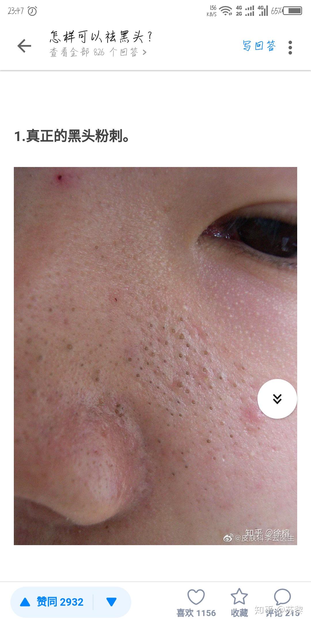 脸颊上能挤出一粒粒黄色颗粒物,这是什么?怎么办才能彻底消除? - 知乎