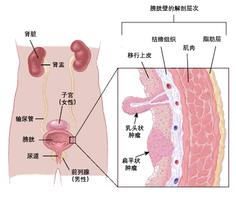 一文读懂膀胱癌的分类 患病风险 筛查和预防 知乎 一文读懂膀胱癌的分类 患病风险 筛查和预防 知乎