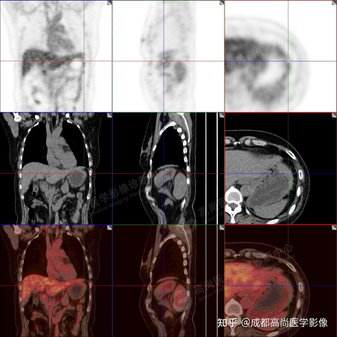【高尚病例】胃MALT淋巴瘤18F-FDG PET/CT表现及临床价值 - 知乎