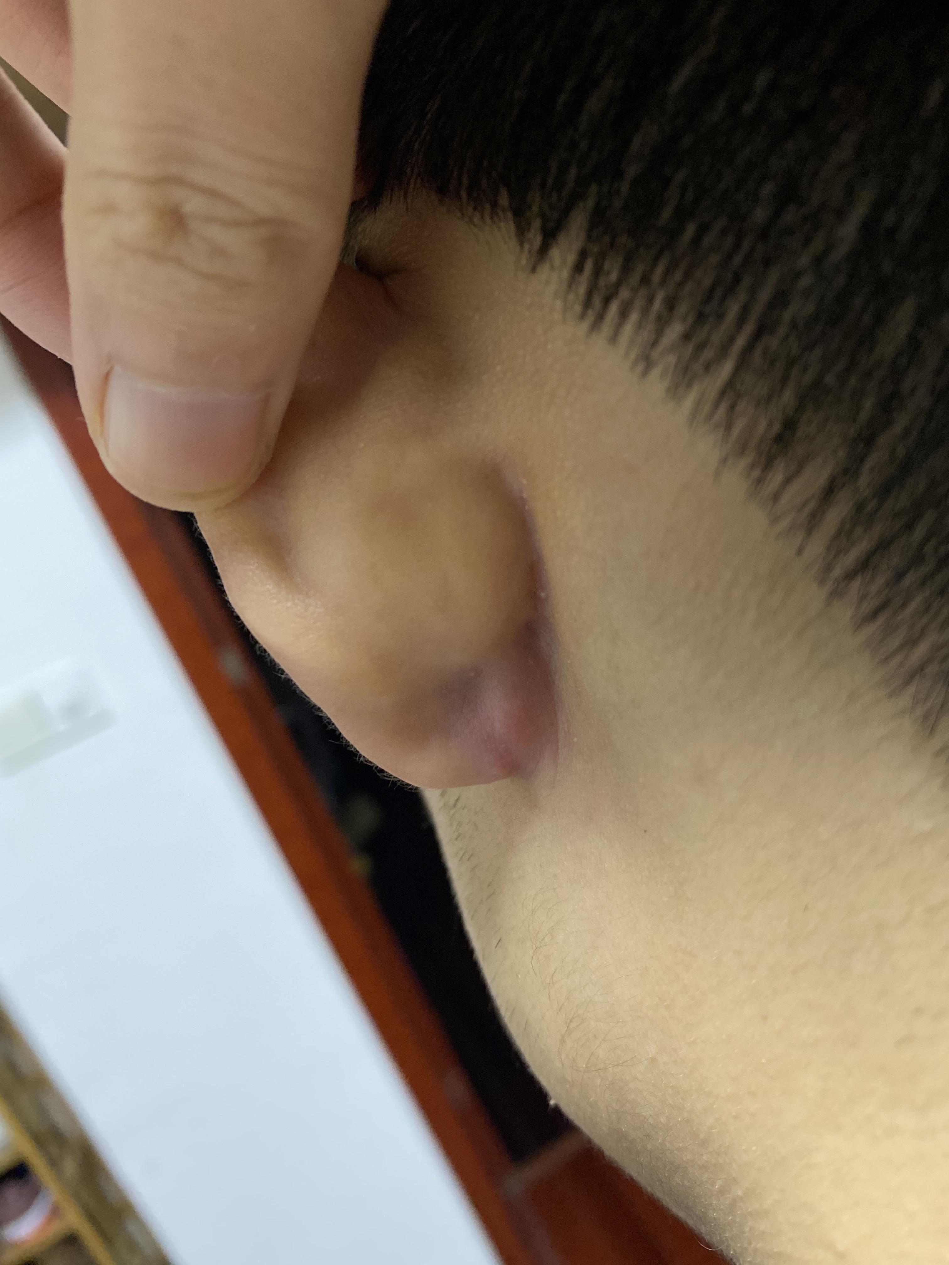 耳垂皮脂腺囊肿手术需要住院吗