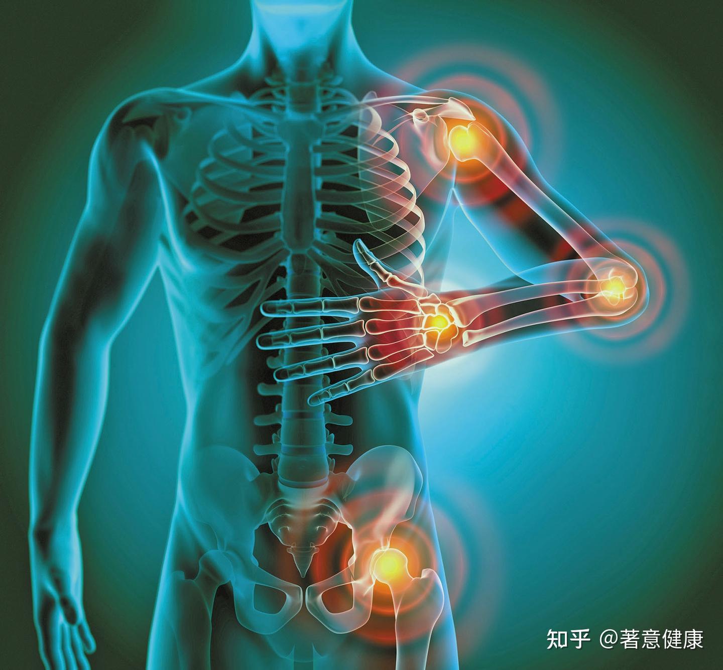 身体发炎了,一定有红肿热痛吗? - 知乎