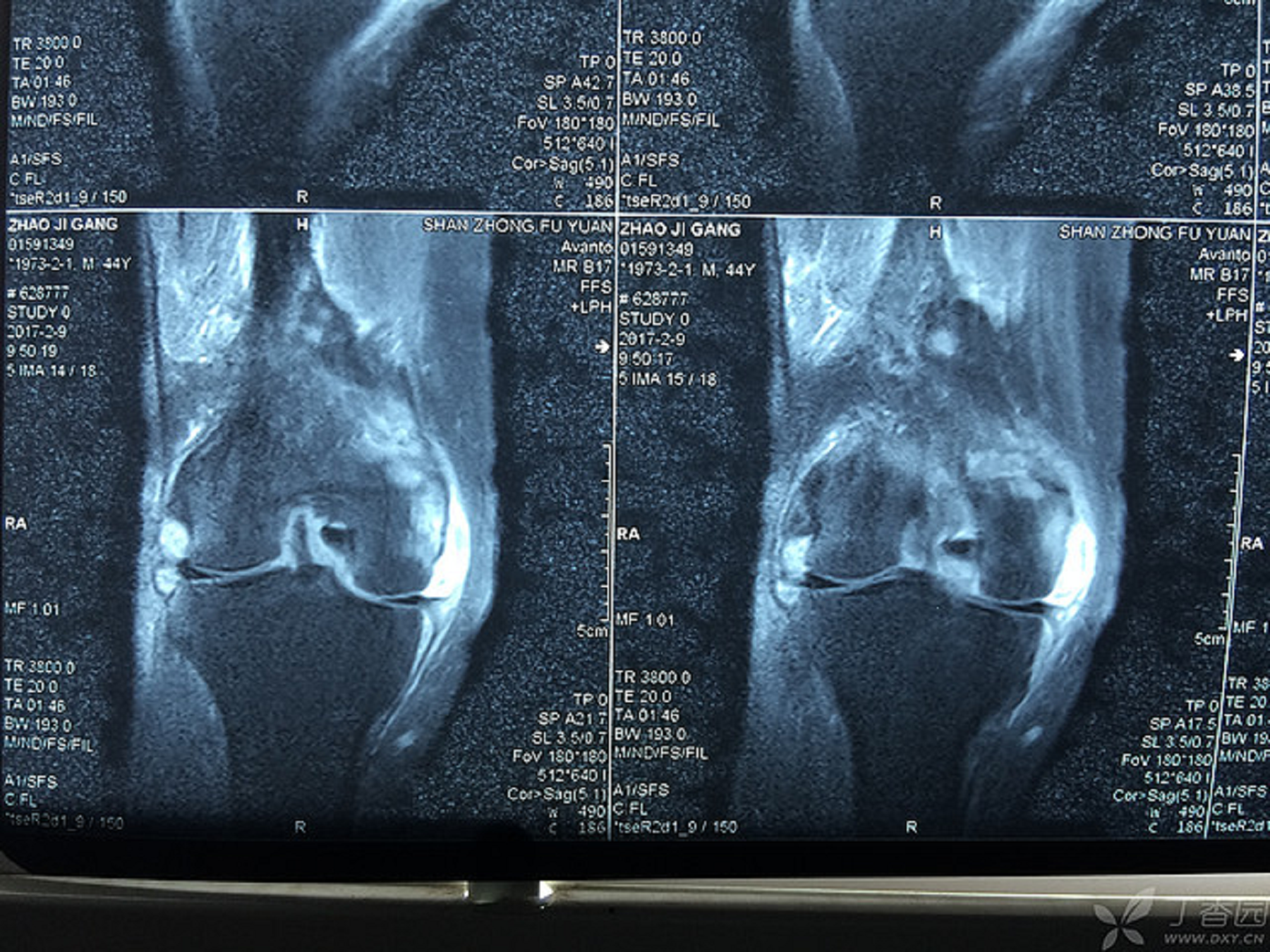 ​滑膜炎终于有救了意想不到的治疗全过程揭秘3年滑膜积液1周消除