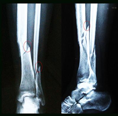骨折和骨裂区别在哪哪个更严重都要手术吗专家教你3点区分