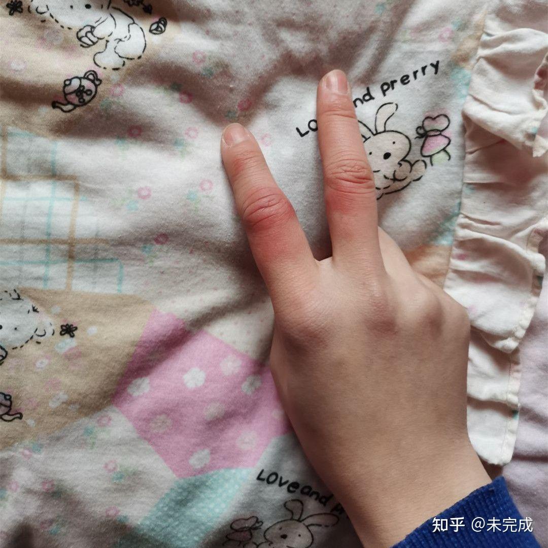 罕见巨指症！2岁男童手指比成年男子还粗 - 城事 - 新湖南