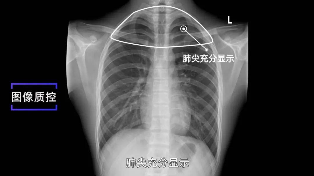 收藏x線攝影技術胸部正側位攝影標準擺位圖文解析